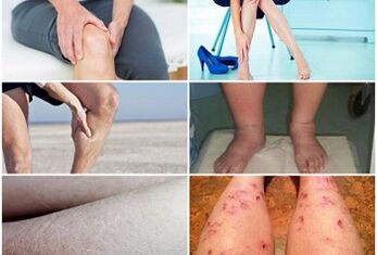 Симптоми на разширени вени на краката