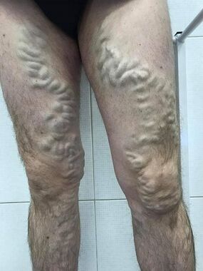 пренебрегвани мъжки разширени вени