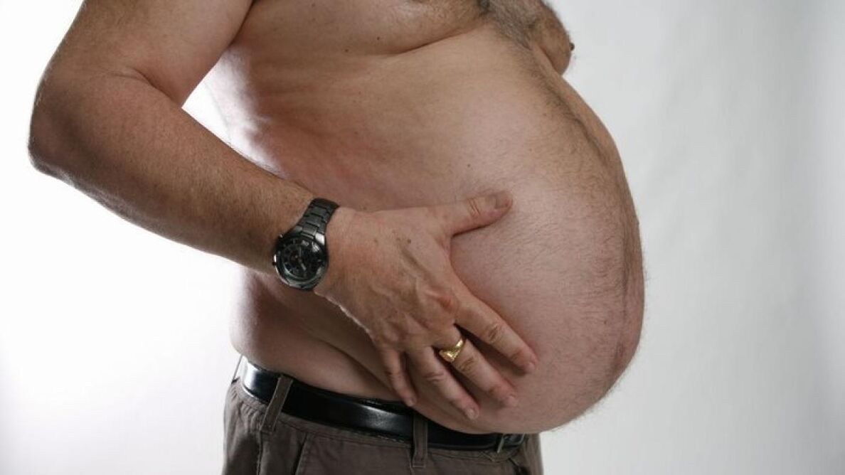 затлъстяването като причина за развитието на разширени вени