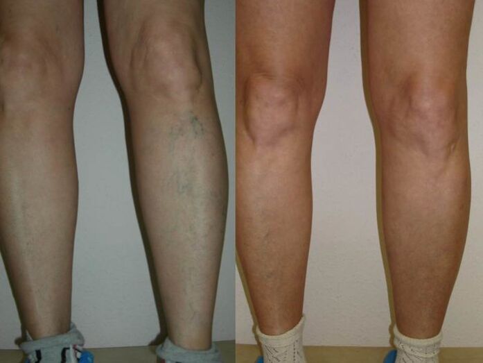 крака преди и след лазерно лечение на разширени вени
