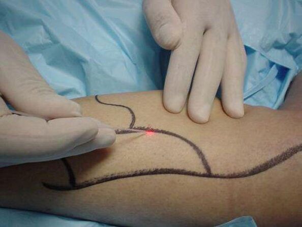 лазерно лечение на разширени вени