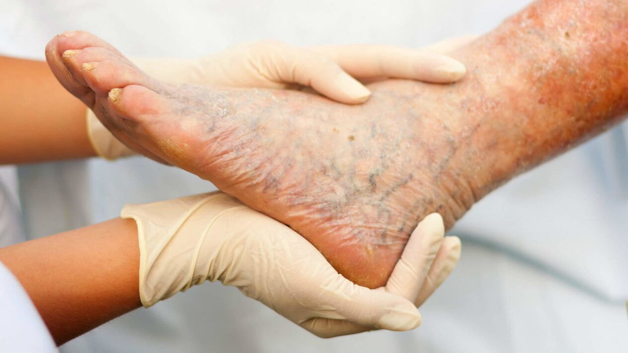 Флебологът се занимава с лечението на разширени вени на краката