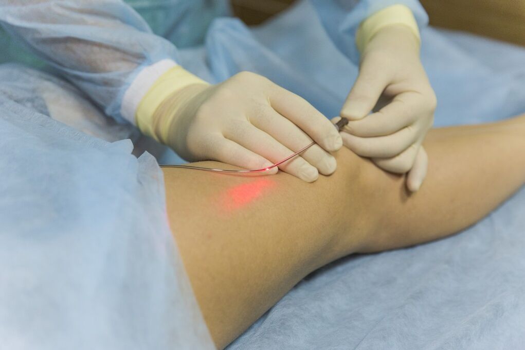 Лазерно лечение на разширени вени на долните крайници