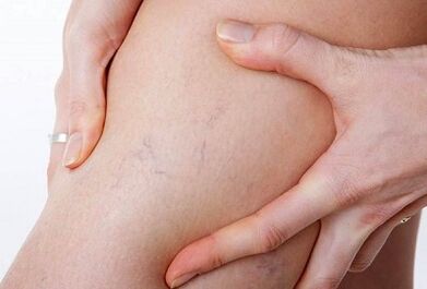 забранени действия за разширени вени